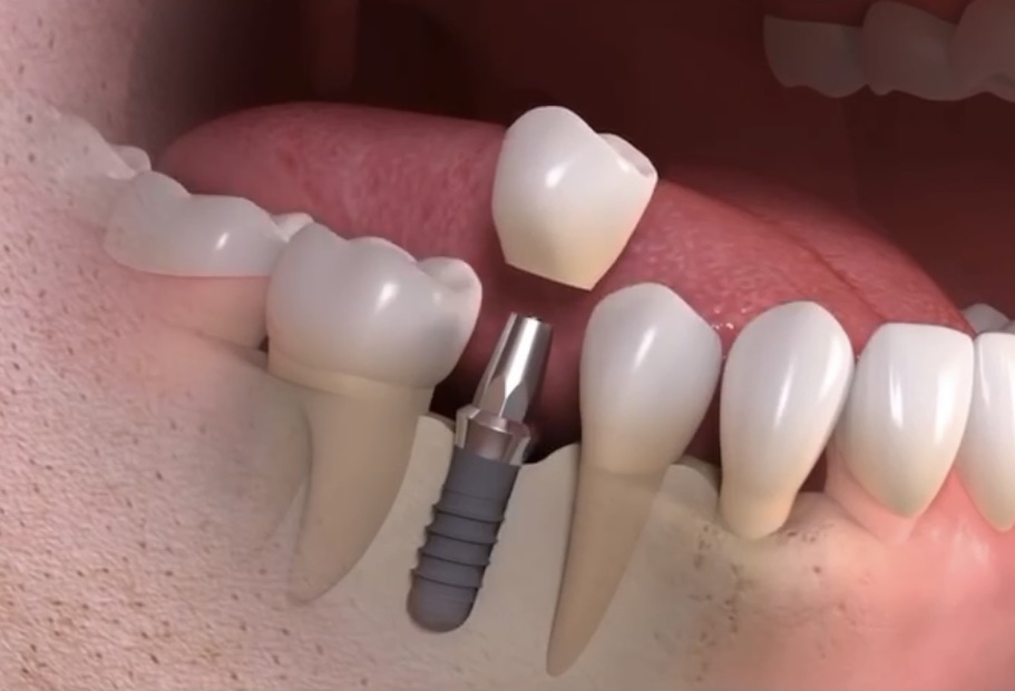 Implantes dentales pagina